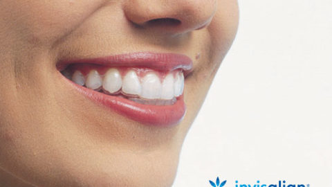 Invisalign_liraodonto