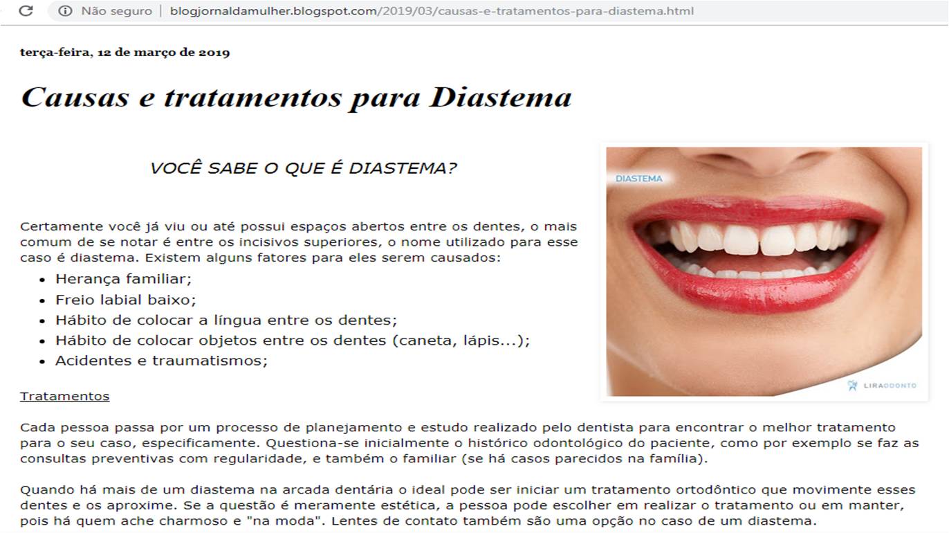 Causas e tratamentos para diastema