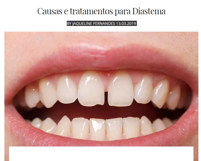 Causas para Diastema