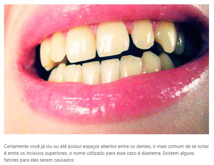 Saiba mais sobre diastema